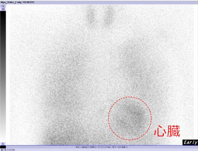 心筋交感神経機能シンチグラフィ検査画像その1
