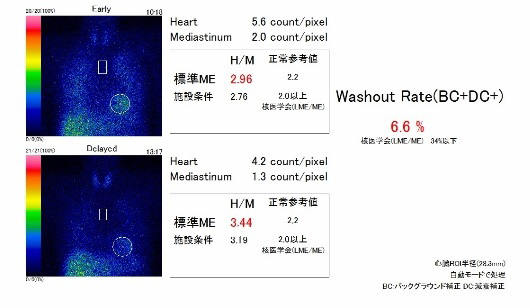 心筋交感神経機能シンチグラフィ検査画像その2